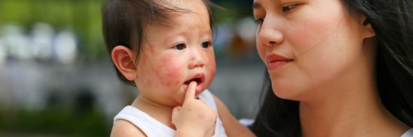 Atopic Dermatitis and Babies: Should You Treat Eczema in Infants with Medications or Naturally?